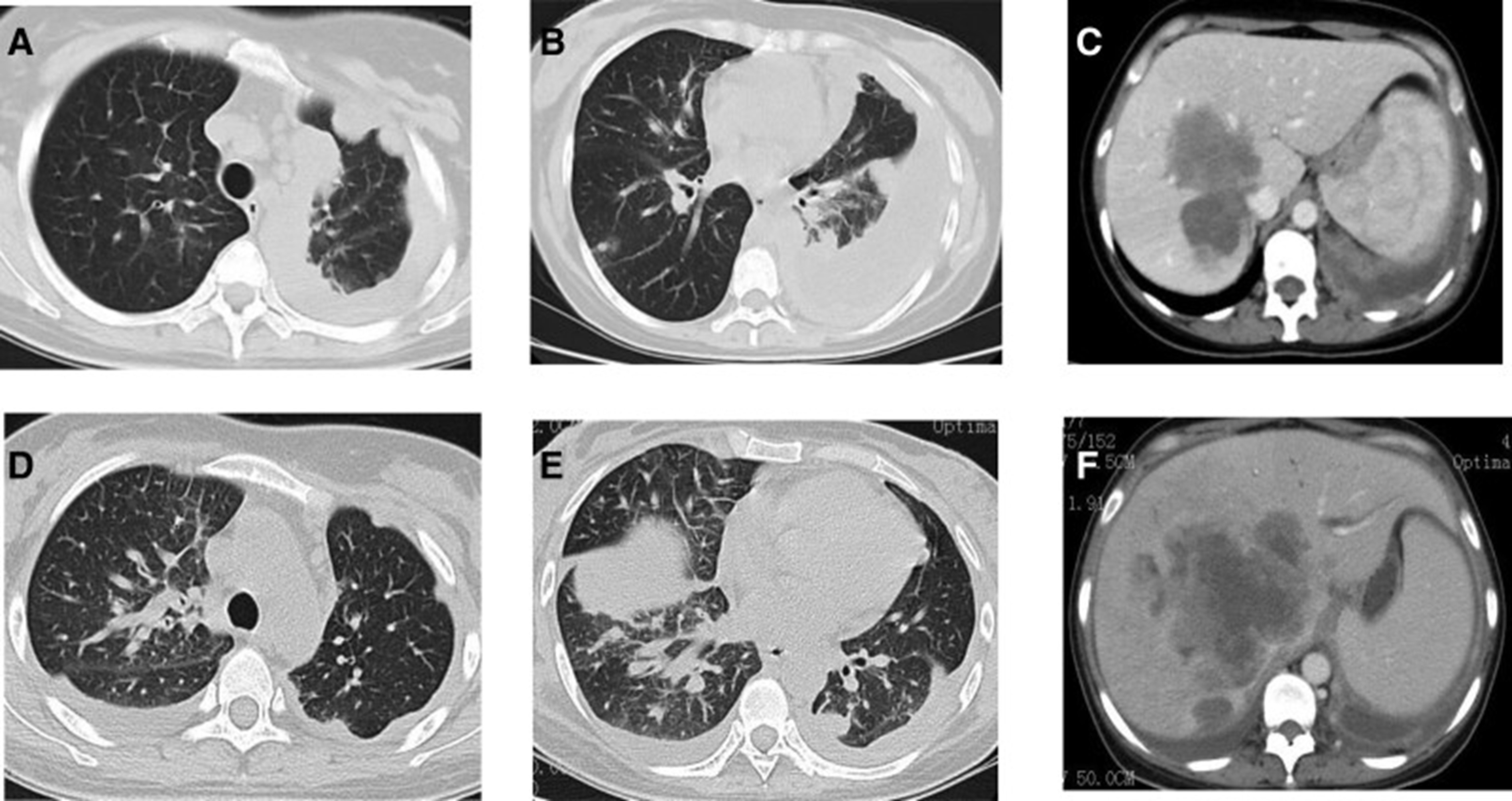 【佳学基因检测】基因检测具有ALK 融合突变而且是高 PD-L1 表达的晚期肺腺癌患者 ALK-TKI 靶向药物治疗